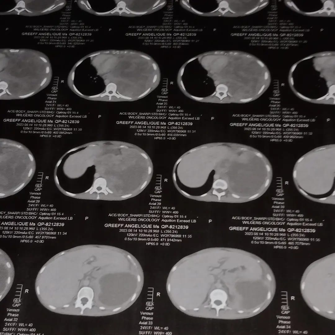 Angie oeh - long kanker